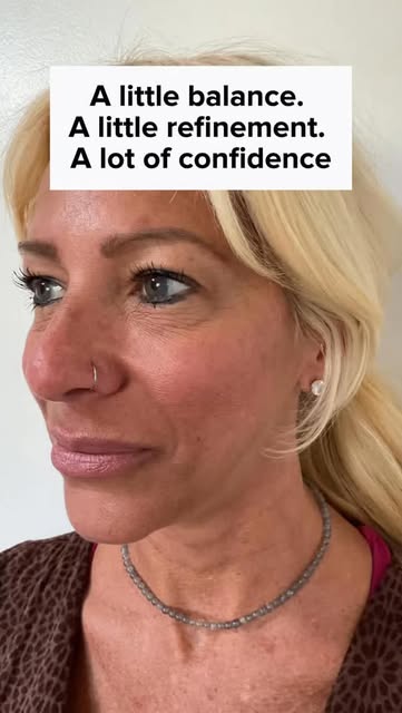 Facial balancing is about enhancing what’s already yours—creating balance, definition, and natural-l