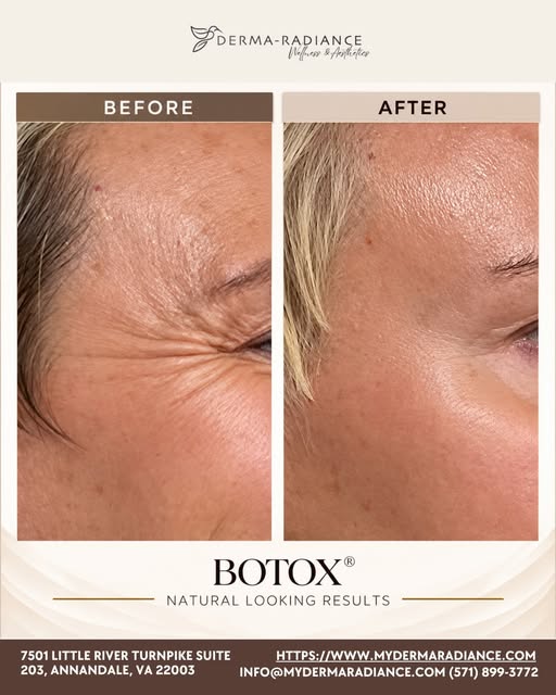 Smoother, refreshed, and still naturally you.

BOTOX® can help soften the appearance of crow’s feet 