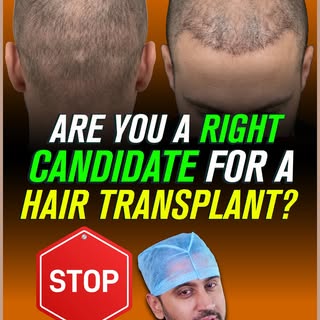 Are you a right candidate for a Hair Transplant?

One of the most important parts of hair restoratio