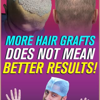 In hair transplantation, just chasing high graft numbers often leads to smaller results.

Grafts are