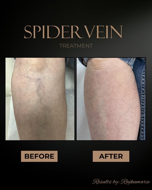 ✨We had to repost this one... because these results are TOO good✨

Spider veins may be small, but th