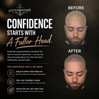 Real talk 🔥
This is what happens when you stop letting hair loss run the show 💯
Before → After wit