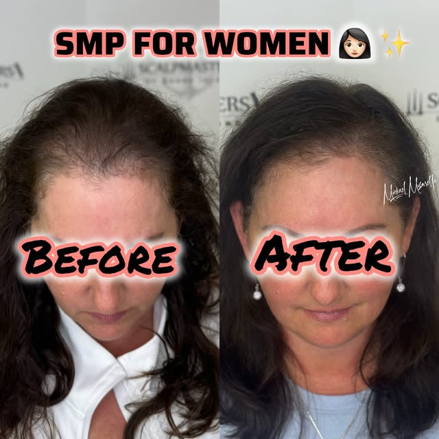 ✨ SMP FOR WOMEN — NATURAL DENSITY, BUILT WITH A PLAN ✨

This is her second session, and the goal isn