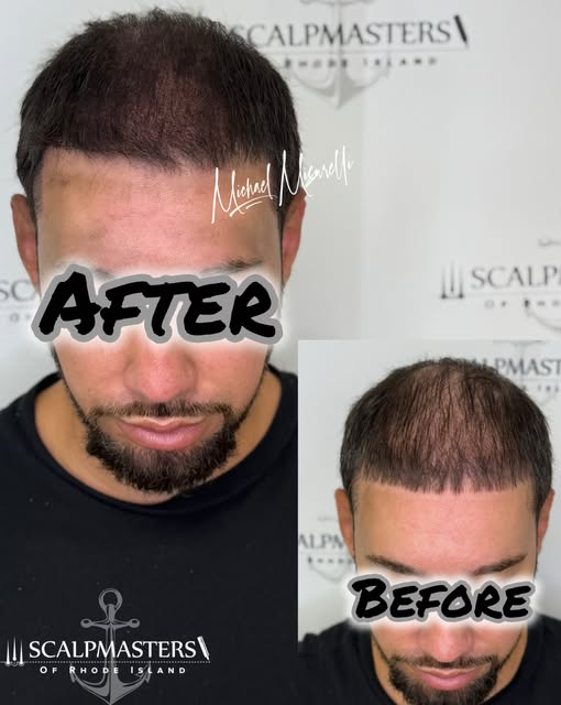 🔥 DENSITY BUILD • SESSION ONE 🔥

Here we have another gentleman who came to us after TWO HAIR TRAN
