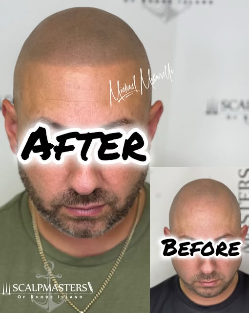 2 YEARS HEALED. 🔥🧬

Before ➡️ After ➡️ 2 years later.

This is the part that matters. ⏳

SMP shoul