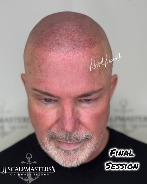 Look at that transition. 🔥🤯

This is what a properly built SMP hairline should look like. ⚓️✨

For