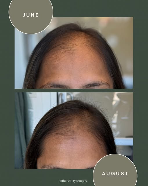Two treatments. Two months. And we’re already seeing significant progress. 👏🏼

When we started, th