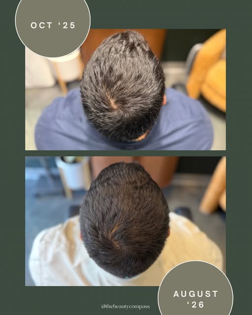 Almost a year later and his growth is still going strong 👍🏼

For context: my client started Alma T