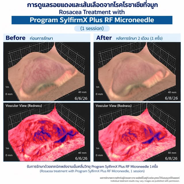 Rosacea บริเวณจมูก กับการดูแลรอยแดงและเส้นเลือด

เคสนี้มีรอยแดงและเส้นเลือดฝอยบริเวณจมูกจาก Rosacea 