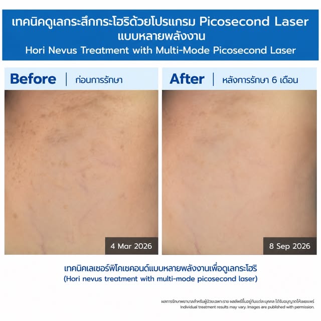 Hori Nevus กับการรักษาด้วย Picosecond Laser แบบหลายพลังงาน

Hori Nevus หรือ Acquired Bilateral Nevus