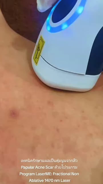 เทคนิครักษาแผลเป็นตุ่มนูนจากสิวPapular Acne Scar ด้วยโปรแกรมProgram LaserME: Fractional Non Ablative