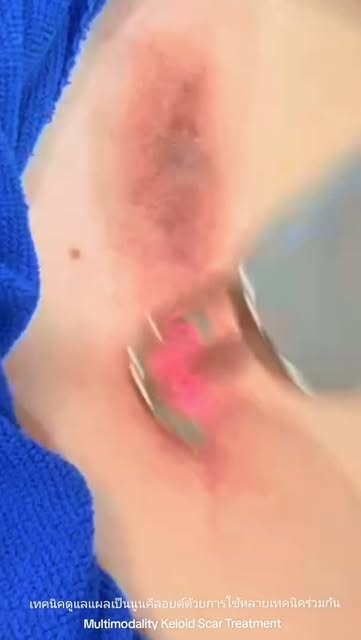 เทคนิคดูแลแผลเป็นนูนคีลอยด์ด้วยการใช้หลายเทคนิคร่วมกัน Multimodality Keloid Scar Treatment  การรักษา