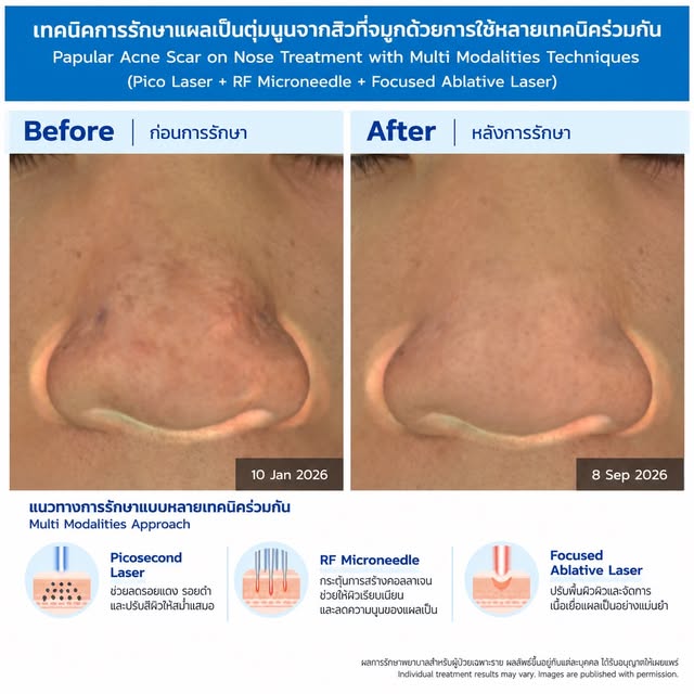 แผลเป็นสิวแบบตุ่มนูนที่จมูก รักษาอย่างไร?

Papular acne scar เป็นแผลเป็นสิวลักษณะตุ่มนูนขนาดเล็ก มัก