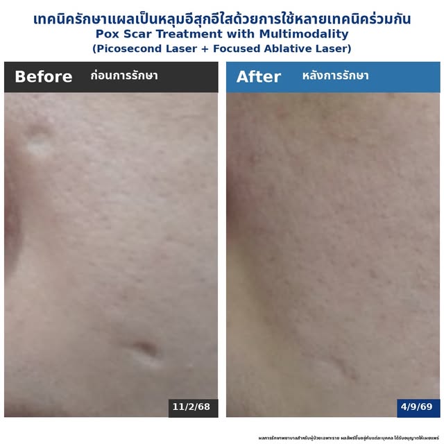 แผลเป็นยุบตัวจากอีสุกอีใส Chickenpox Scars มีลักษณะ & ดูแลได้อย่างไร?

Characteristics and Managemen