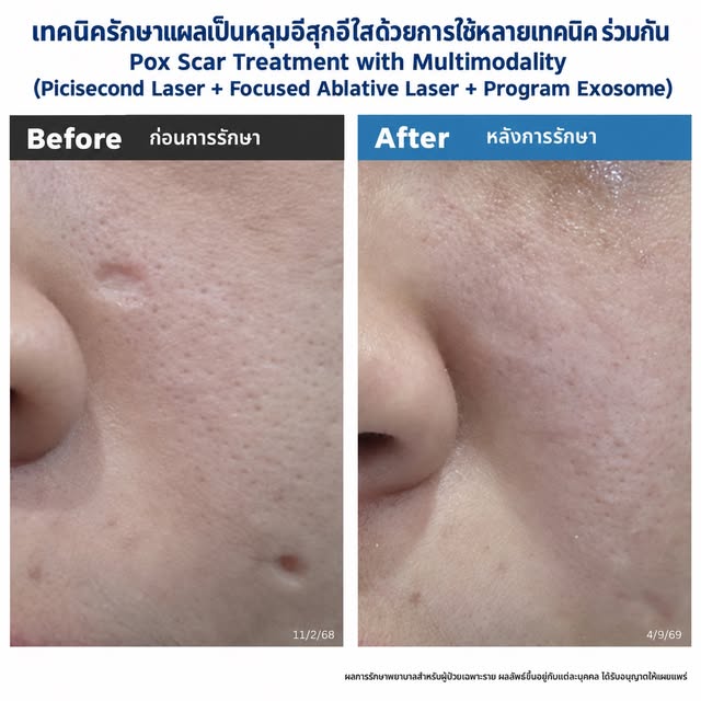 แผลเป็นยุบตัวจากอีสุกอีใส Chickenpox Scars มีลักษณะ & ดูแลได้อย่างไร?

Characteristics and Managemen