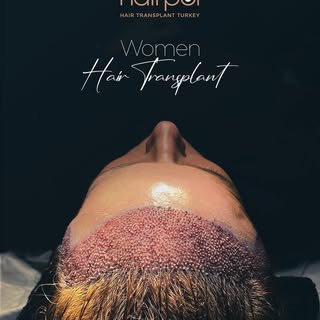 With our DHI (Direct Hair Implantation) technique, women can restore their hair without shaving. Ach