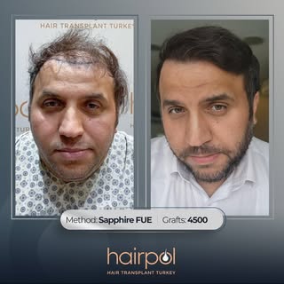 This is a completed hair transplant process.🤌

First of all, feeling good about yourself is the key