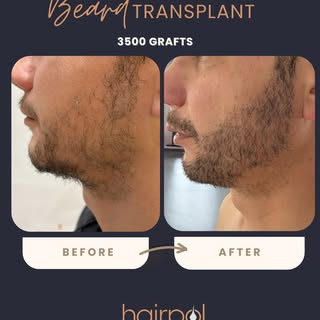 Our Beard Transplant result! ✨
Our patient is happy and of course we are very happy too!🤩

Contact 