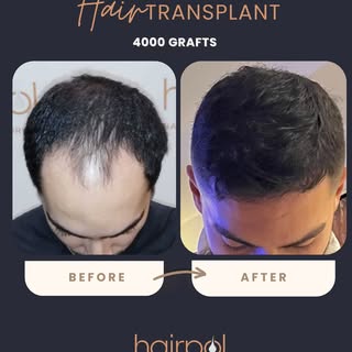 And the procedure is complete. 👌
Still undecided about a hair transplant?
Come meet us!🤩

Get info