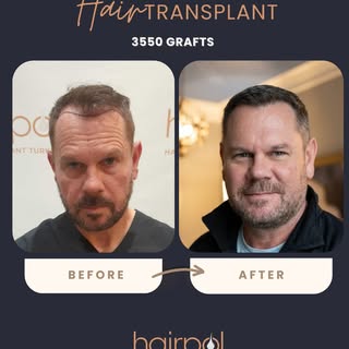 ✨Natural hairline and strong density🤩 — another successful result for our American patient.🇺🇸
Con