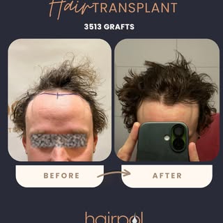 We’ve received another new result from Canada 🇨🇦✨
Still undecided about getting a hair transplant?