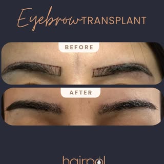 Natural brows. Lasting confidence. ✨

Every eyebrow transplant is carefully designed to complement t