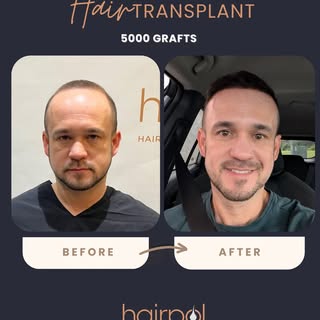 We’re delighted to share the hair transplant journey of our dear American patient, @bruksariza 🇺🇸✨