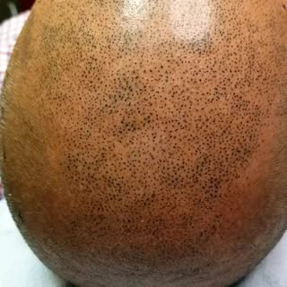 Poor guy! Glad we could help! 

#smp #scalpmicropigmentation #dermimatch #hairloss #scarcamouflage #