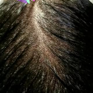 #smp #scalpmicropigmentation #dermimatch #hairloss #scarcamouflage #phoenix #scottsdale #az #arizona