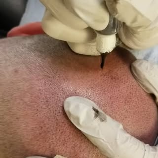 Smooth 😜 

#smp #scalpmicropigmentation #dermimatch #hairloss #scarcamouflage #phoenix #scottsdale 