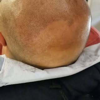 #smp #scalpmicropigmentation #dermimatch #hairloss #scarcamouflage #phoenix #scottsdale #az #arizona