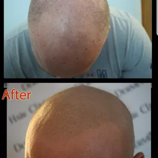 Natural Results 🔥😎
#smp #scalpmicropigmentation #dermimatch #hairloss #scarcamouflage #phoenix #sc