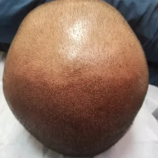 No editing no filter no special lighting. 

#smp #scalpmicropigmentation #dermimatch #hairloss #scar