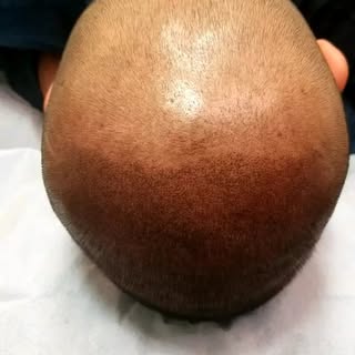 #smp #scalpmicropigmentation #dermimatch #hairloss #scarcamouflage #phoenix #scottsdale #az #arizona