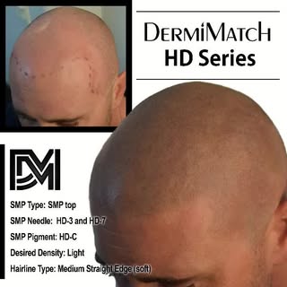 With superior pigments and needling, Garrett Duell, at DermiMatch Hair Clinic is able to produce the