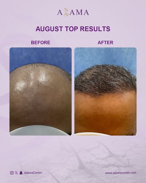 نتائج مميزة في زراعة الشعر ✨

في مركز أدمة نحرص على تصميم خطة علاج تناسب كل حالة، بهدف الوصول إلى مظ