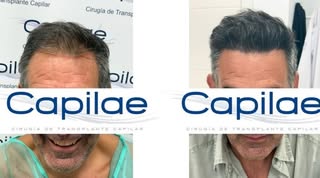 Seguimos demostrando por qué CaPiLae es la clínica mejor valorada de trasplante capilar  en Madrid (