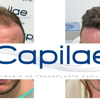 Pues este es un paciente después de 9 meses de la cirugía, con rediseño de la zona frontal e hiperde