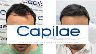 Acabamos esta semana de cirugías a tope con este resultado a tan solo 6 meses de la intervención. Ob