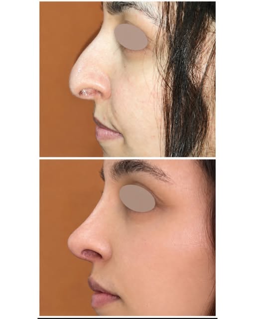 Rhinoplasty should refine the nose without changing the patient’s identity.
These before-and-after v
