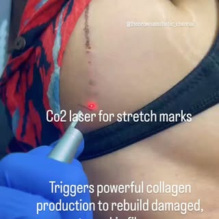 Stretch marks treatment @thebrownaesthetic_chennai 
Call 📞 9363223016
#c02 #stretchmark #clearskin 