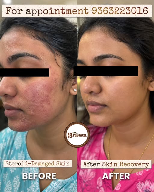 Free consultation for steroid abuse skin concerns 
For appointment call 📞 93632 23016 
@thebrownaes