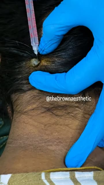Dm@thebrownaesthetic_chennai 
#SkinHealth #skincare #skintagremoval #WartTreatment #clearskin