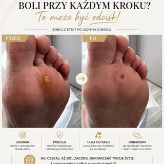 🚨 Myślisz, że odcisk to tylko “twarda skóra”? To jeden z najczęstszych mitów.

Ten niewielki odcisk