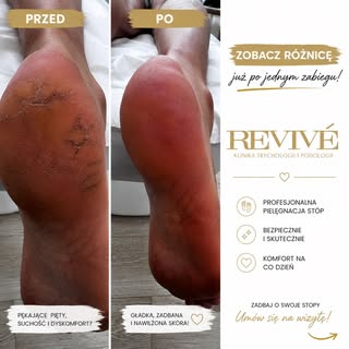 🚨 Popękane pięty to nie tylko problem estetyczny.

Sucha, zrogowaciała skóra i głębokie pęknięcia m