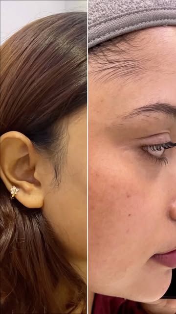 The result speaks for itself. ✨
Before vs After 🤍

#pigmentation #drsafiabithy #melasma #skincare #