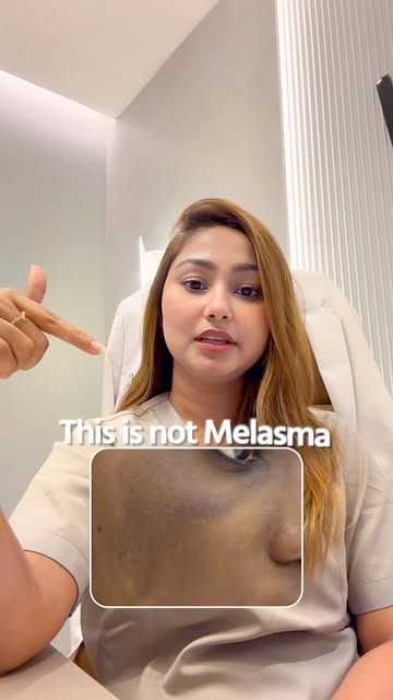 This is not Melasma… know your pigmentation before starting the treatment.. 
#melasma #lyevbeverlyhi