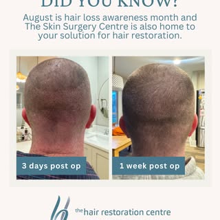August is Hair Loss Awareness Month, and we're here to help you take the first step toward restoring