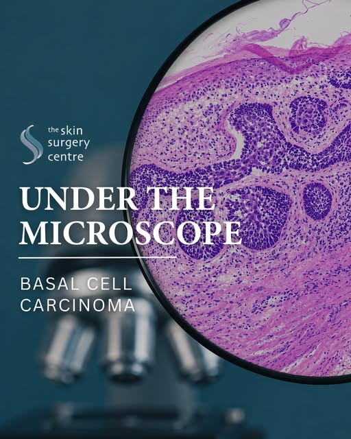 Basal cell carcinoma (BCC) is the most common type of skin cancer. While it often grows slowly, earl