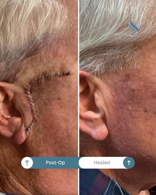 Healing that speaks for itself. 💙 From the immediate post-op result to a beautifully healed outcome